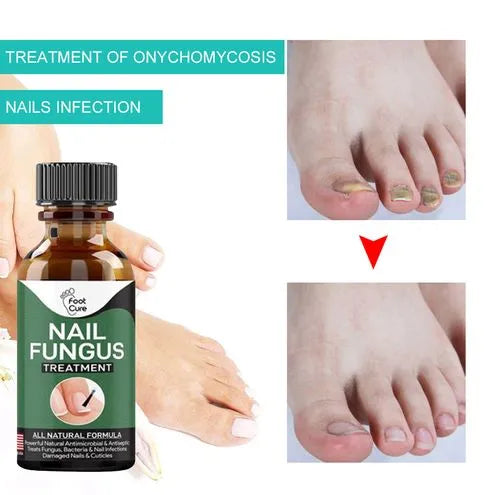 Foot Nail Fungus Treatment Serum